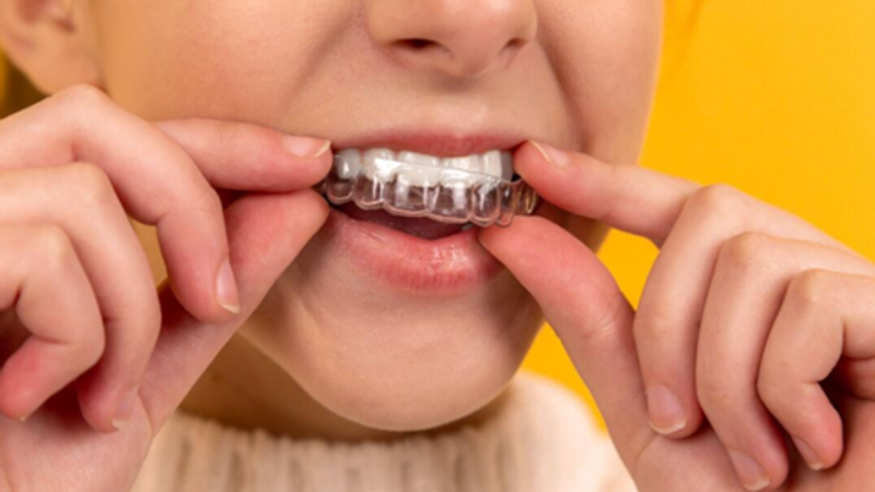 The Pros and Cons of Popular Invisalign Alternatives