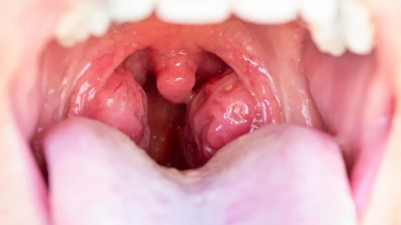 Understanding Hidden Tonsil Stones: Causes, Symptoms, and Treatment