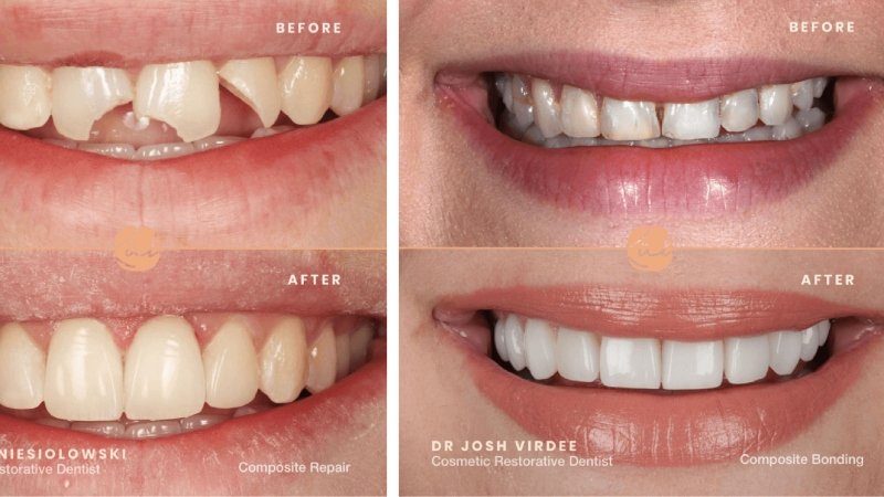 How to Correct Crooked Bottom Teeth: Treatment Options Explained