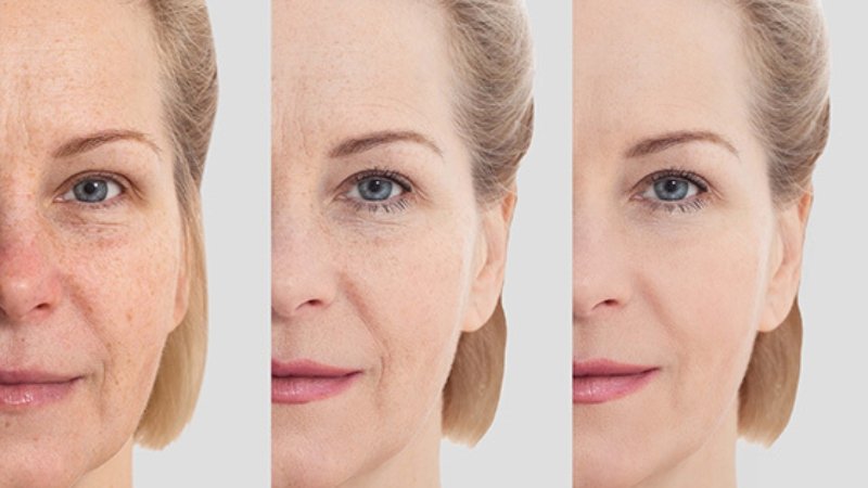 The Benefits of Face Lift Treatment for a Youthful Appearance