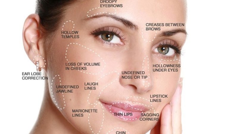 The Benefits of Having the Best Dermal Fillers in 4 Key Facial Zones