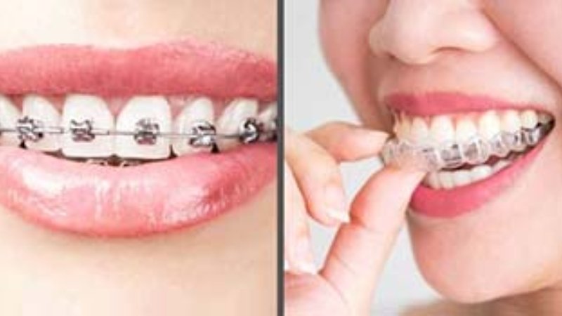 Transparent Braces vs. Traditional Braces: Which is Right for You?