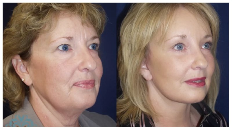 Top 4 Types of Facelifts and When to Consider Each